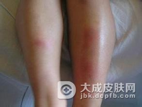 如何防止结节性红斑的病发