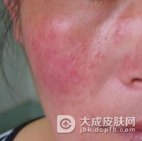 生活中怎样预防过敏性皮炎