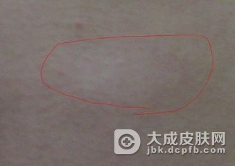 青少年白癜风的临床症状有哪些？