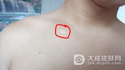 刚出现白癜风是什么样的
