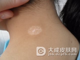 白癜风不及时治疗，危害究竟有多大