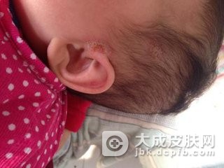 耳部出现湿疹要怎么办