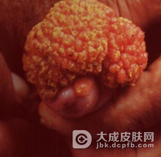 尖锐湿疣在生活里会有怎样的表现
