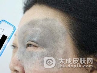 导致太田痣的病因有什么