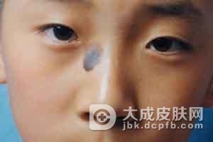 太田痣比较明显的特征是什么
