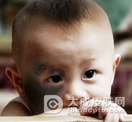 黑色太田痣会遗传吗
