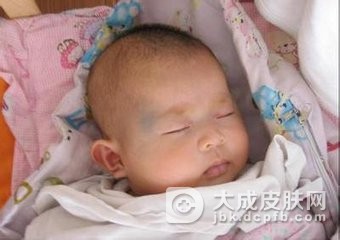 太田痣术后护理的措施有什么呢