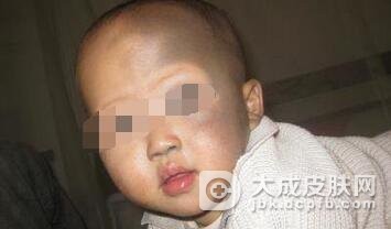 太田痣治疗后应该如何护理