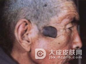 疣状角化不良病常见症状