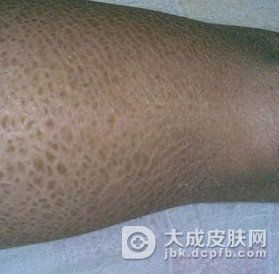 生活中如何有效治疗鱼鳞病