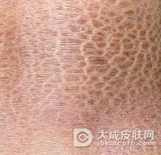 皮肤干燥属于鱼鳞病吗