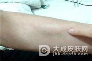 临床上皮下脂肪瘤的治疗方法