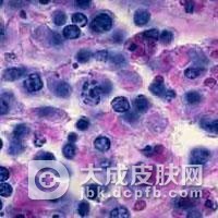 杜波组织胞浆菌病常见症状