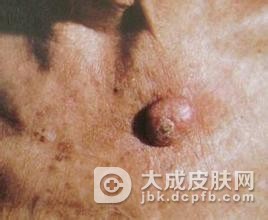 发疹型角化棘皮瘤的症状表现