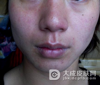 小儿皮肤过敏的常见症状有哪些呢