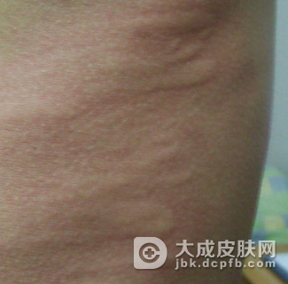 为什么会频繁出现皮肤过敏呢