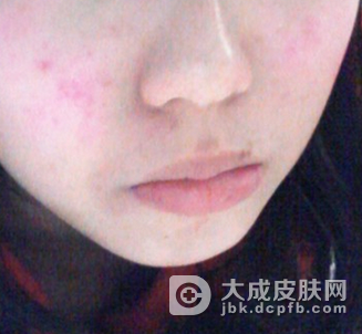 皮肤过敏患者在日常生活中该注意什么
