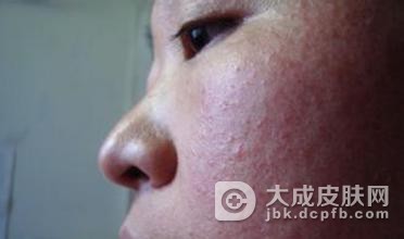 如何预防疱疹样皮炎的发生