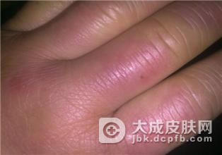 专家讲解红斑狼疮遗传吗