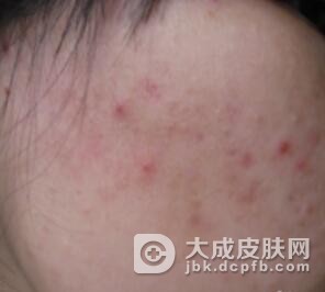 专家教你正确认识痤疮的特点