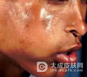 哪些方法可以预防硬皮病的发生