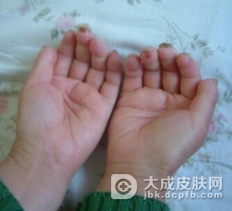 硬皮病患者的自我护理方法有哪些呢