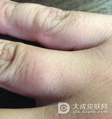 硬皮病的护理方法有哪些啊