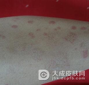 怎么才能治好玫瑰糠疹