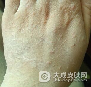 治疗玫瑰糠疹的药膏