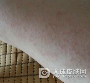玫瑰糠疹应该吃什么食物好呢