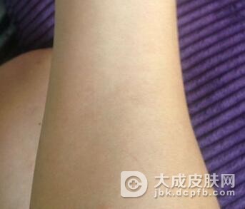 玫瑰糠疹同其他疾病的鉴别诊断