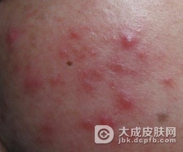 什么情况下容易发生青春痘