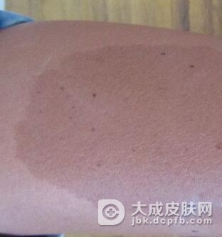 哪些人容易得咖啡斑