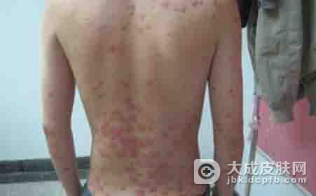 盘状红斑狼疮的皮损特点
