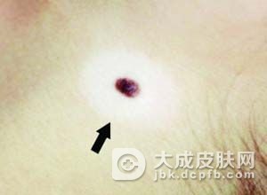 肉瘤皮肤转移有哪些表现及如何诊断