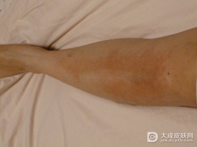 脚部湿疹应该注意些什么_腿脚部湿疹护理_大成皮肤网