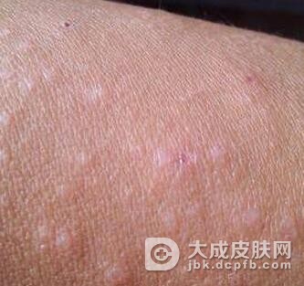 怎样护理日光性皮炎