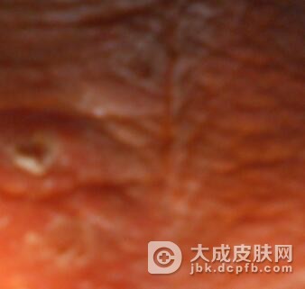 治疗阴囊湿疹方法有什么呢