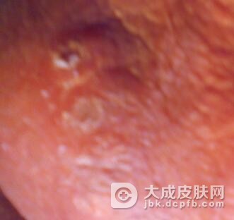 阴囊湿疹的症状判断方法