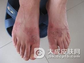 角化型脚气是什么