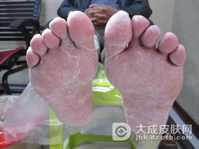 脚气给患者带来哪些并发症