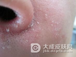 面部脂溢性皮炎的引发因素有哪些