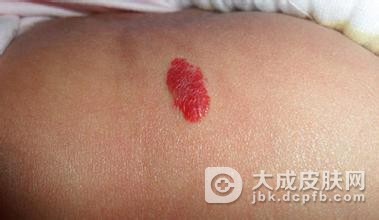 常见的婴儿毛细血管瘤三大症状