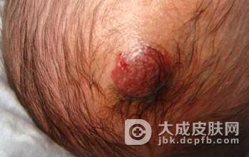 毛细血管瘤有什么损害呢