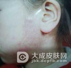 什么是婴儿毛细血管瘤