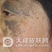 太田痣具有遗传性吗