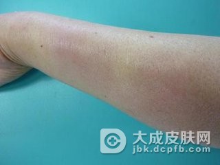 结节性红斑会有哪些危害
