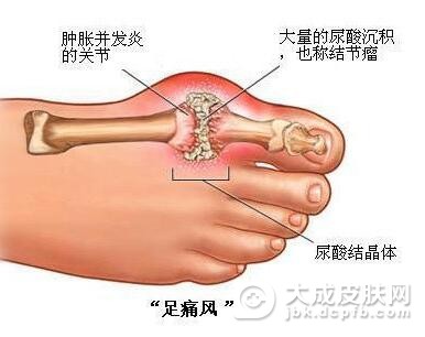 对于痛风有哪些认知误区