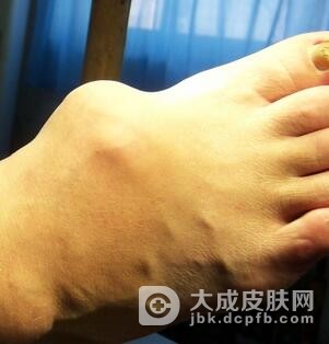 痛风病有哪些征兆呢