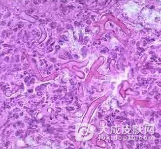 中医如何治疗霉菌性阴道炎呢